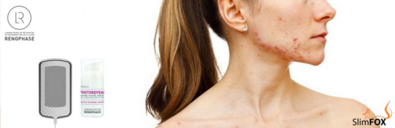 setrny-peeling-renophase-s-led-terapii